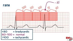 EKG Interpretation EM in 5